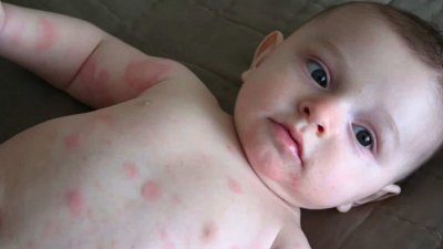 Проявления в детском возрасте пищевой аллергии